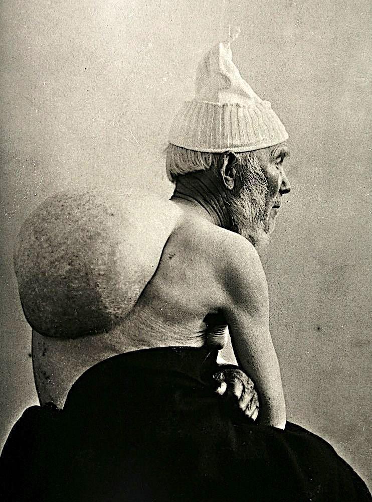 Люди с мутациями на снимках 19-го века 