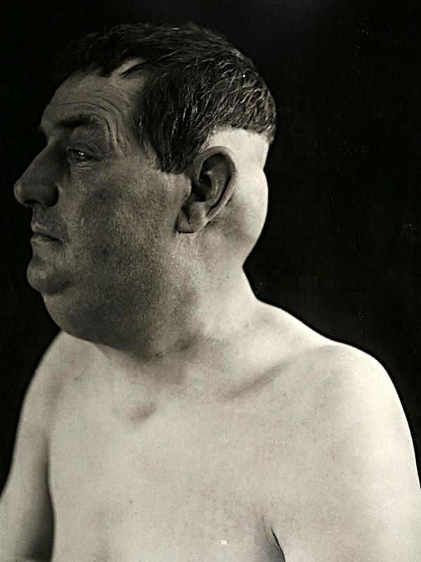Люди с мутациями на снимках 19-го века 